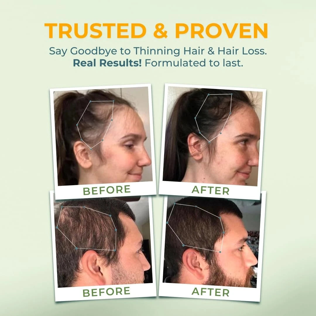 Vital Hair Complex – Biotin & Vitamin B Hair Vitamins for Women & Men